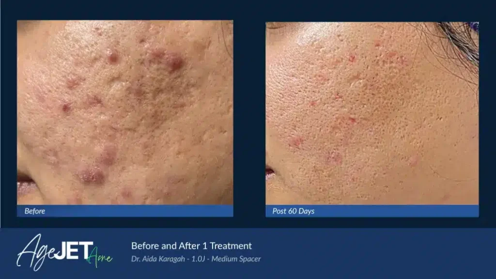 04-BA_AgeJet-Acne-Female-_-Karagah