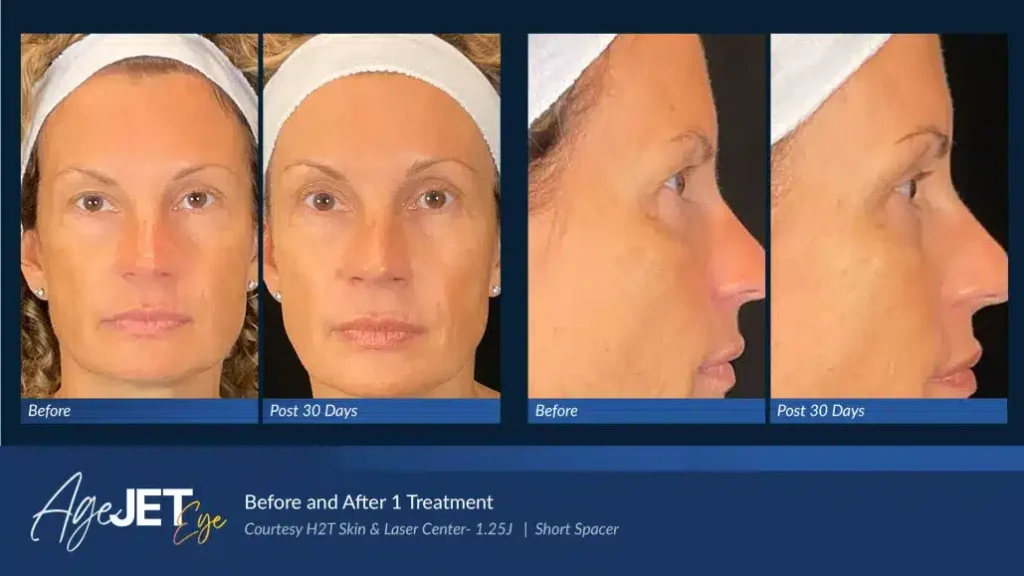 05-AgeJET-Before-and-AftersAgeJet-Eye_Female_Deep
