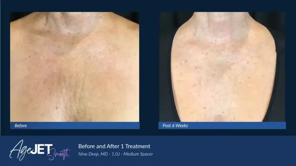 07-BA_AgeJet-Smooth-Female-_-Deep-Chest