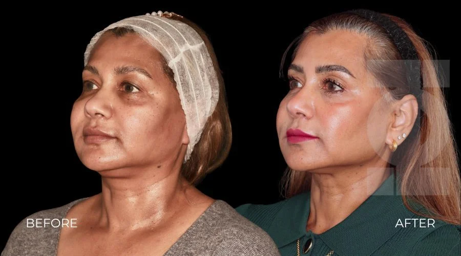 skin_tightening_endolift_results_3154bcc16c
