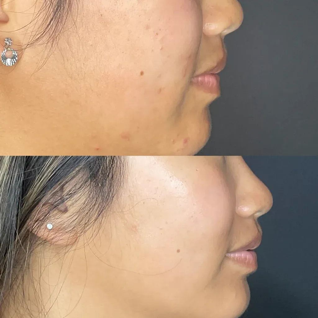 imgi_63_Oxygeneo-Facial-before-n-After-1-1024x1024