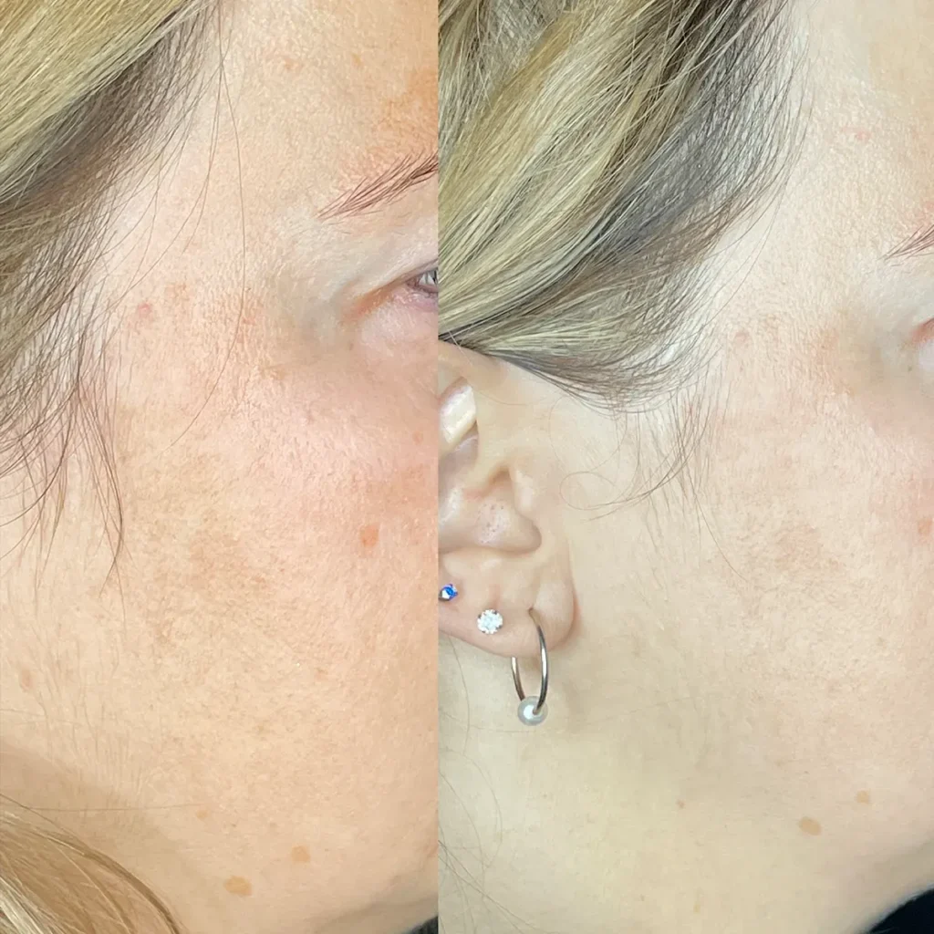 imgi_6_Oxygeneo-Facial-before-n-After-4