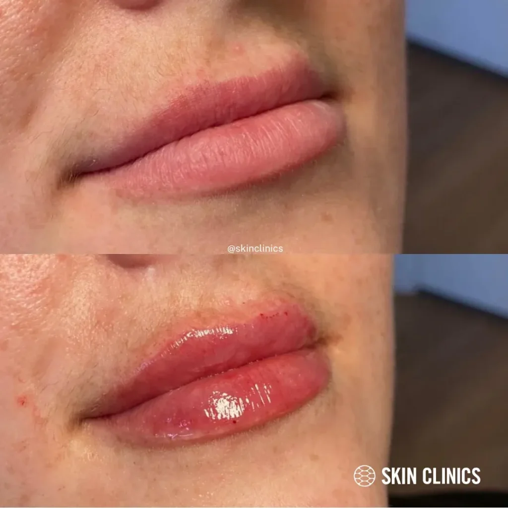 imgi_73_lip-fillers-in-calgary-1