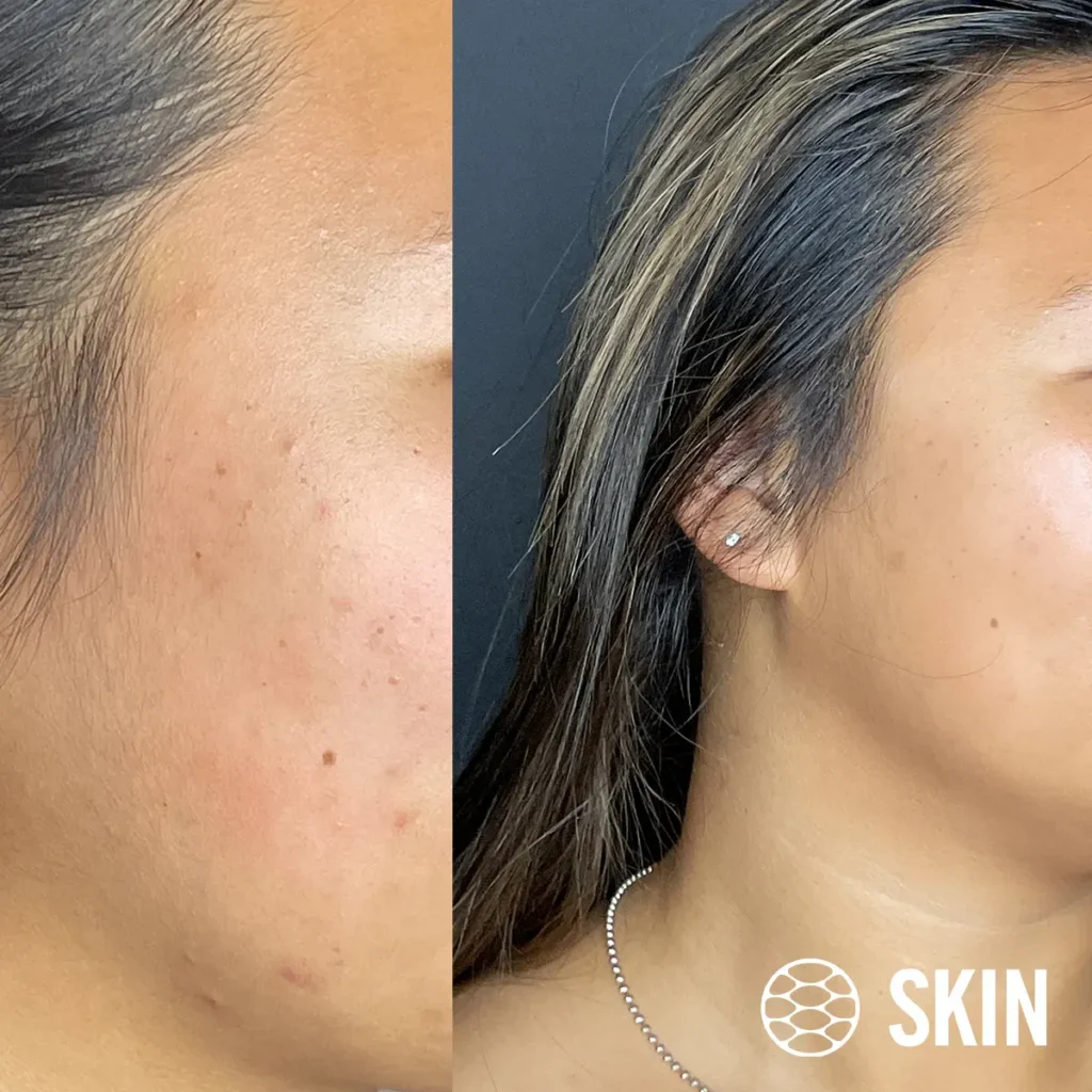 imgi_7_Oxygeneo-Facial-before-n-After